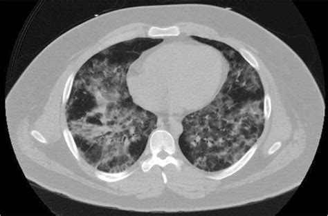 Axial Ct Chest Without Iv Contrast Diffuse Interlobular Septal