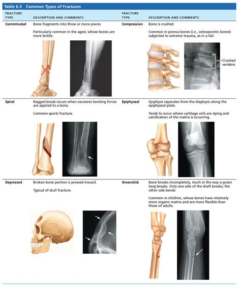 Common Types Of Fractures With Illustrations And Brief Descriptions