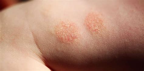 Nummular Dermatitis Symptoms Clear Skin Clinic