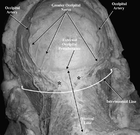 The Relationship Of The Right And Left Greater Occipital Nerves At