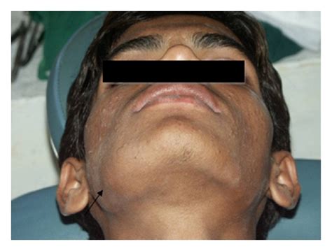 Extraoral Photograph Showing Swelling In The Right Side Mandibular