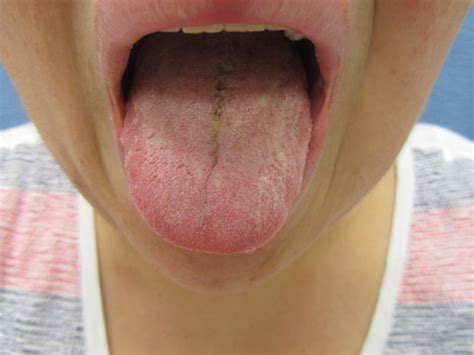 A 40 Year Old Female With Left Sided Facial Swelling And Lip Swelling