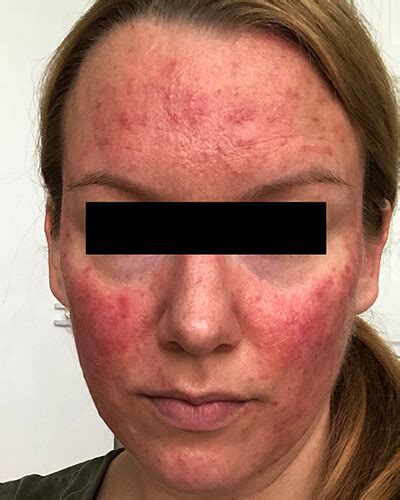 The Many Faces Of Rosacea