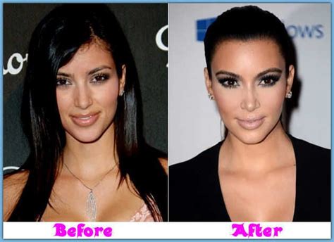 Kim Kardashian Nose Job Before And After Nose Jobs Before And After