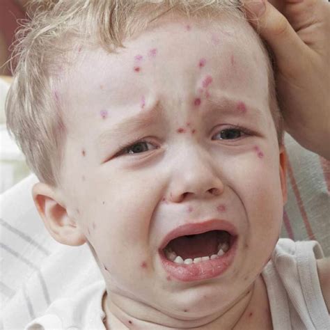 Symptoms Of Chickenpox In Babies Pictures Symptoms And Pictures