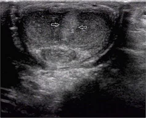 Frontiers Ultrasound On Erect Penis Improves Plaque Identification In