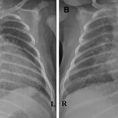 Chest X Rays Showing Cardiomegaly Hilar Congestion And Download