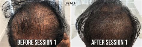 What does smp stand for? Scalp Micropigmentation SMP for Long Hair in Birmingham UK ...