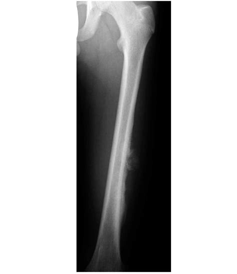 Anteroposterior Radiograph Of A Left Femur Showing A High Grade Surface