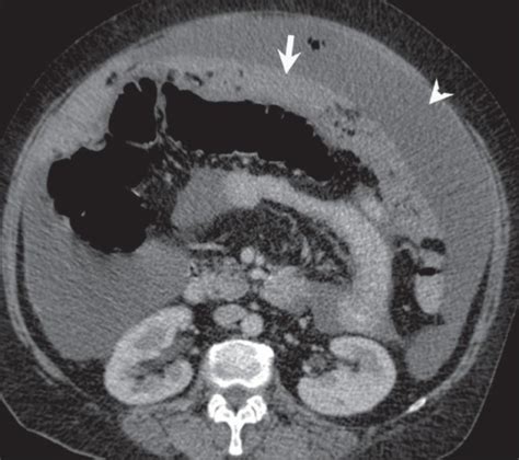 Peritoneal Carcinomatosis Omental Caking Arrow And A Open I