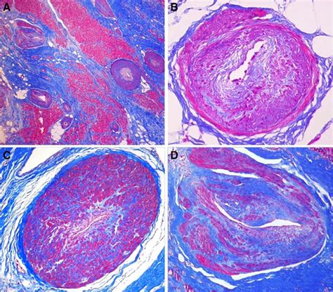 Histological And Histometric Characterization Of Myocardial Fibrosis In