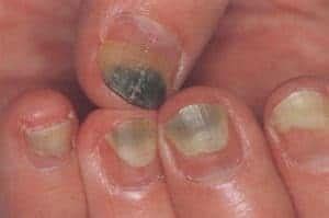 Posted in nail fungus, nail fungus cause, nail fungus treatment, toenail fungus treatment. Understanding "Green" Nail Stains - The Nail Lady