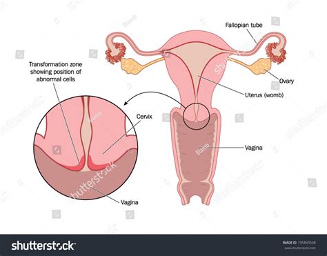 Transformation Zone Cervix Labelled Stock Vector 195843548 Shutterstock