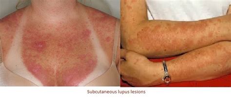Lupus Rash Types Effects Diagnoses Treatments Prevention And