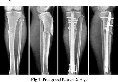Figure 1 From Functional Outcome Of Proximal Third Tibial Fractures