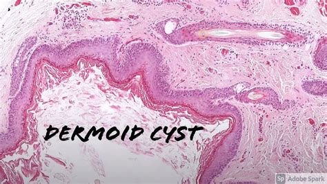 Epidermal Inclusion Cyst Histology