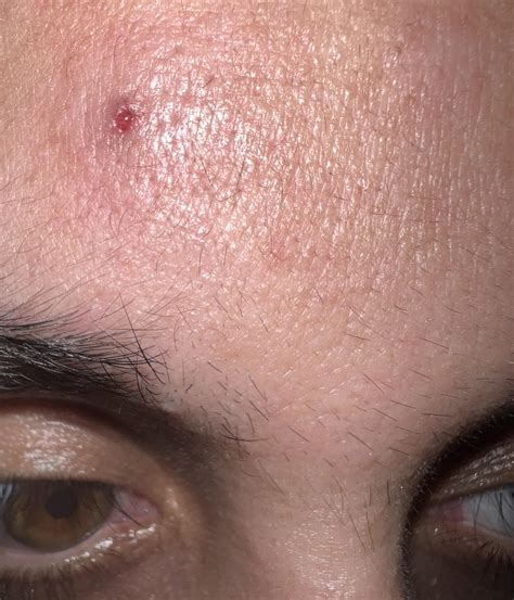 Didn’t think to video it, but a blackhead left a huge gaper on my