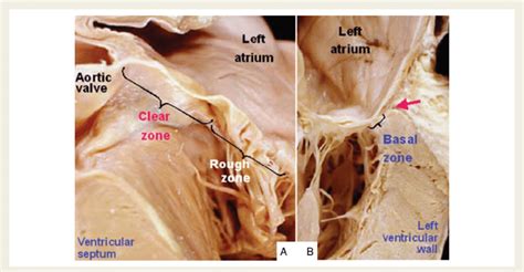 A The Aortic Leaflet Of The Mitral Valve Is In Fibrous Continuity