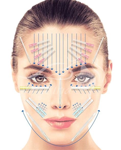 A Comprehensive Guide To Pdo Thread Lift Yastrid Medical Aesthetic