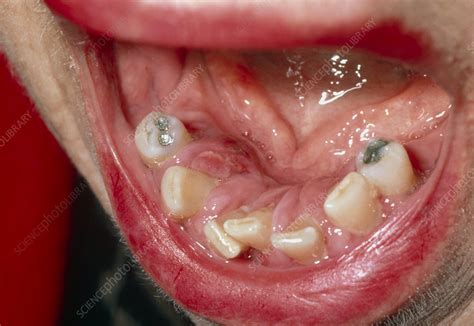 Close Up Of Swollen And Inflamed Gums Gingivitis Stock Image M782