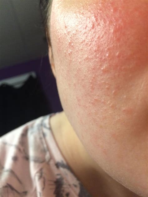 Skin Concerns Bumpy Texture That Wont Go Away