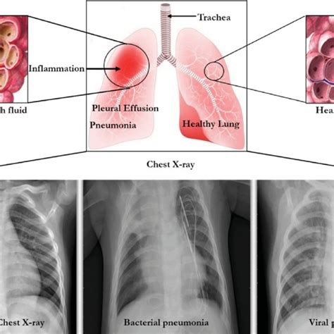 the lungs and chest x rays showing inflammation leading to pneumonia download scientific