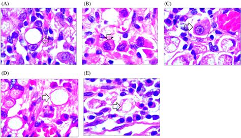 Clinicopathological Characteristics Of Signet‐ring Cell Carcinoma