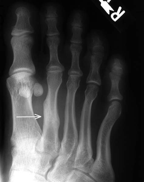 How To Treat Foot Stress Fractures Our Brisbane Podiatrists Explain