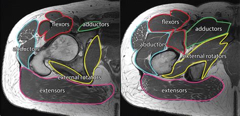 US And MRI Of Pelvic Tendon Anatomy And Pathologic Conditions RadioGraphics