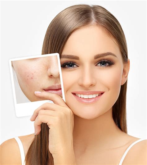 How To Treat Acne Scars Theforbiz