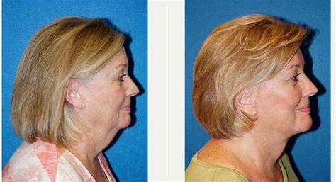 66 Year Old Woman Treated With Facelift Before And After By Doctor Joseph