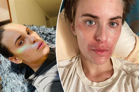 Tallulah Willis Posts Before And After Skincare Photos