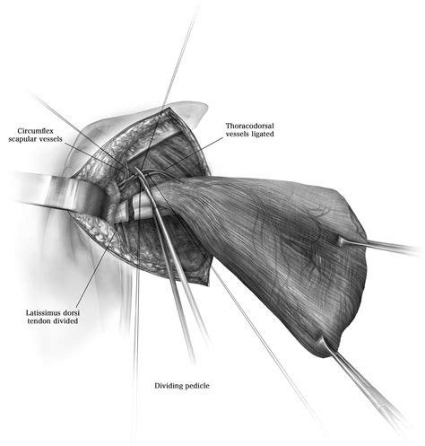 Latissimus Dorsi Muscle Harvest Operative Techniques In Thoracic And