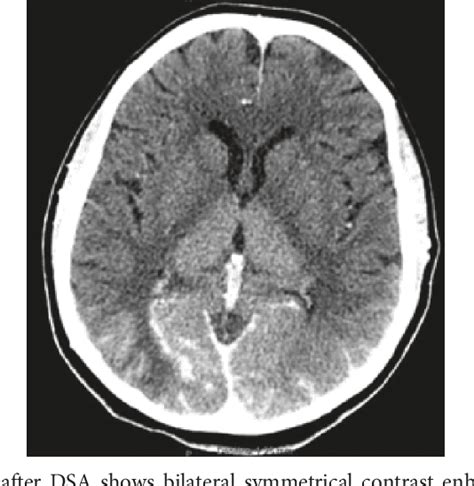 Figure 1 From Contrast Induced Encephalopathy Following Cerebral