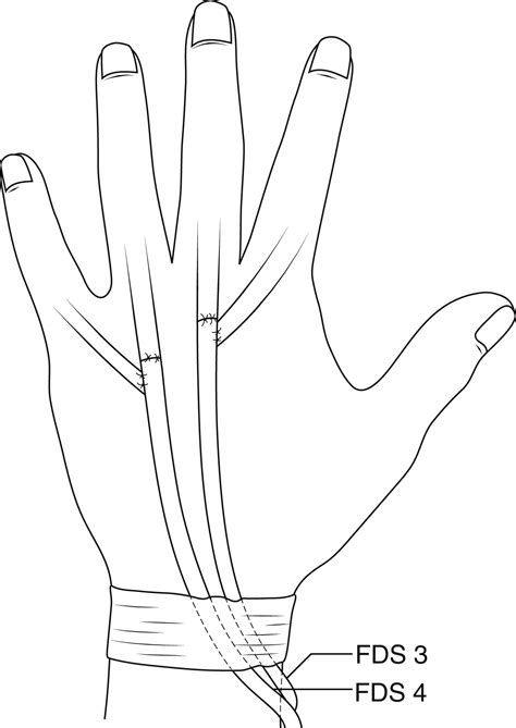 Tendon Transfers In The Rheumatoid Hand For Reconstruction Hand Clinics