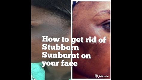 This soothes the burn, while also helping the skin to heal. HOW TO GET RID OF STUBBORN SUNBURN | REMOVE SUNBURN FAST ...