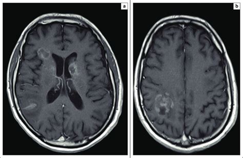 Post Gadolinium Contrast Enhanced T1 Axial Slices From Mr Brain