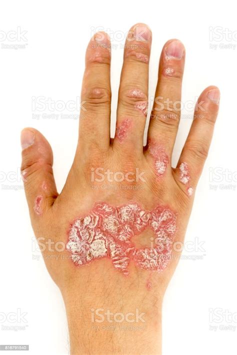 Psoriasis Vulgaris On The Man Hand And Finger Nails With Plaque Rash