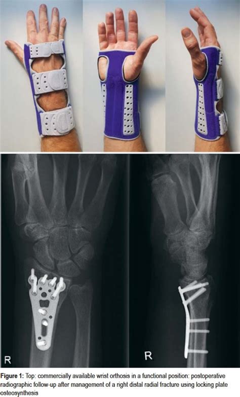 Early Mobilization Versus Splinting After Surgical Management Of Distal Radius Fractures