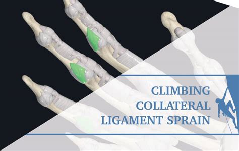 Collateral Ligament Finger Injuries In Climbers The Climbing Doctor