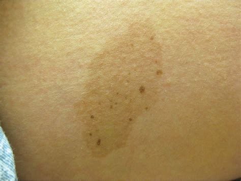 Pigmented Lesions And Melanoma Plastic Surgery Key