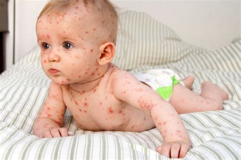 Many viral infections can cause a rash in addition to other symptoms. Pictures of Viral Rashes in Adults & Children