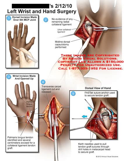 Amicus Illustration Of Amicus Surgery Wrist Hand Mcp Metacarpophalangeal Joint Radial Collateral