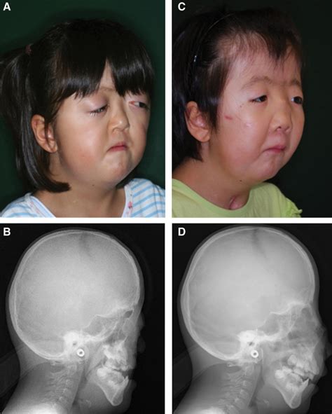 Patient 2 A 10 Year Old Female Patient With Apert Syndrome A