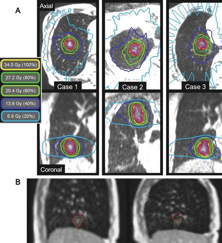 Mri Guided Radiation Therapy An Emerging Paradigm In Adaptive
