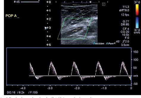 Figure 7 From Ultrasound Guided Percutaneous Aspiration Of Adventitial