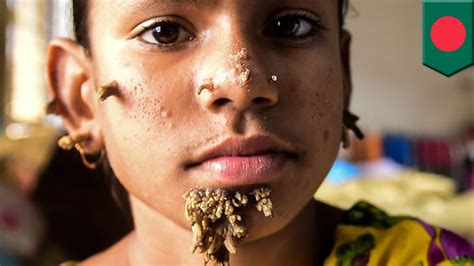 Tree Man Disease Bangladeshi Girl 10 Might Be First Female With Rare