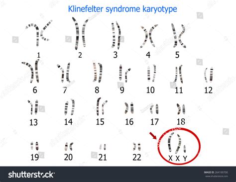 Klinefelter Syndrome Karyotype Stock Illustration Shutterstock