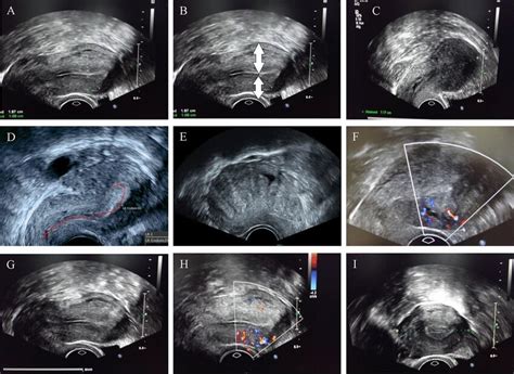 Adenomyosis Specific Sonographic Markers A Asymmetric Walls Of Uterus