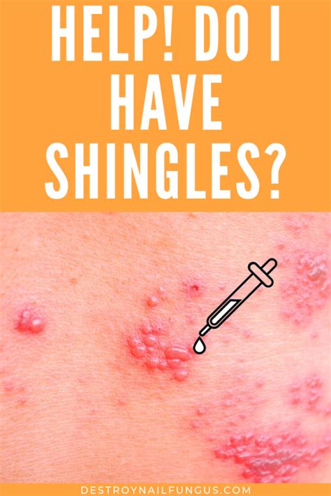 What Are The Signs That You Have Shingles Read This To Find Out